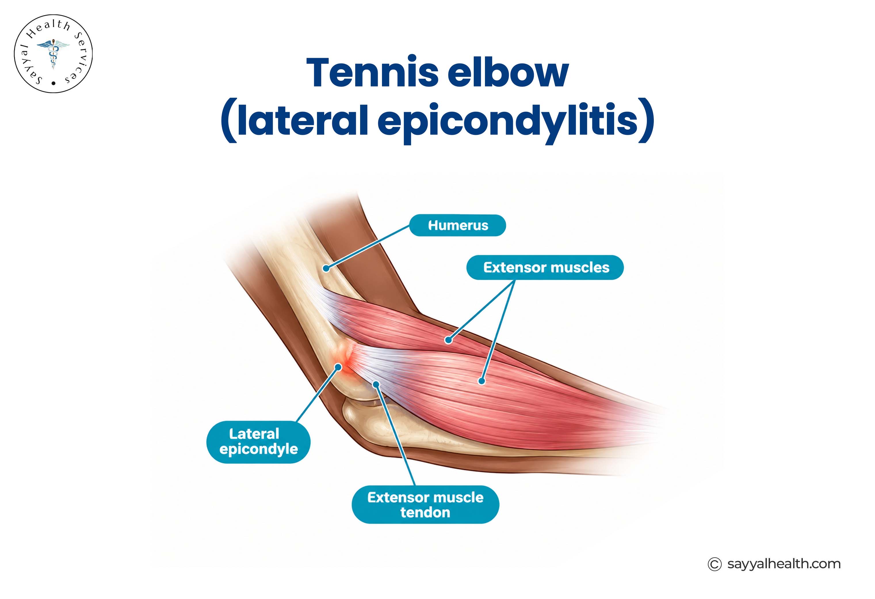 prp for tennis elbow